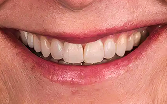After Mia Aligners treatment