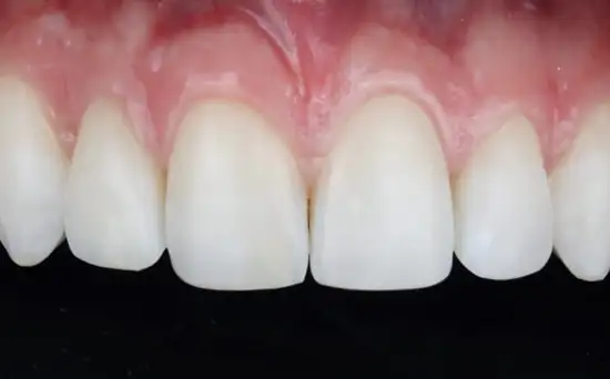 After teeth whitening