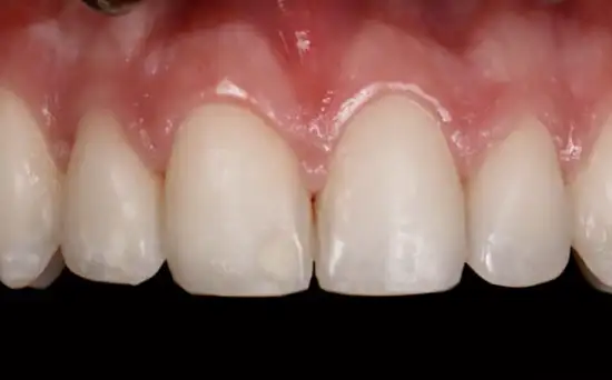 Before teeth whitening