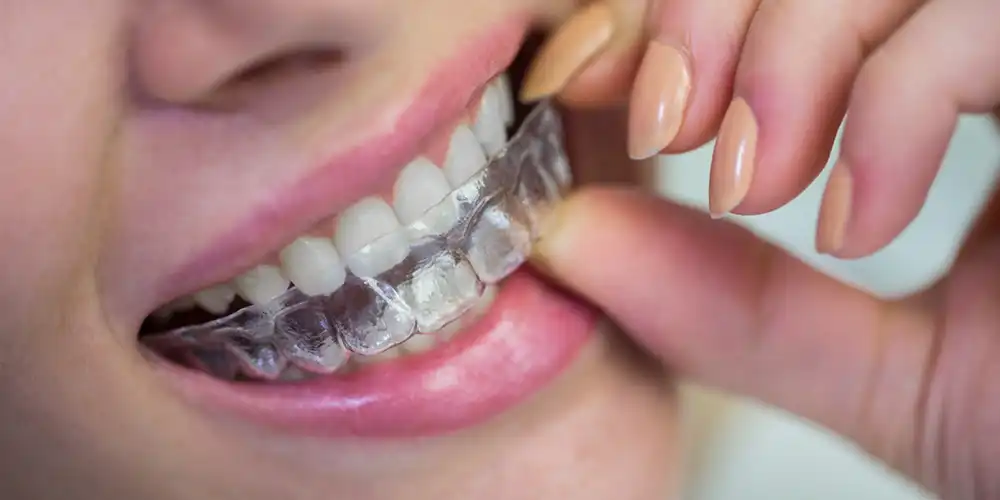 Clear Aligners