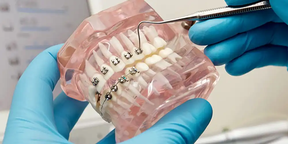Dental Bridges