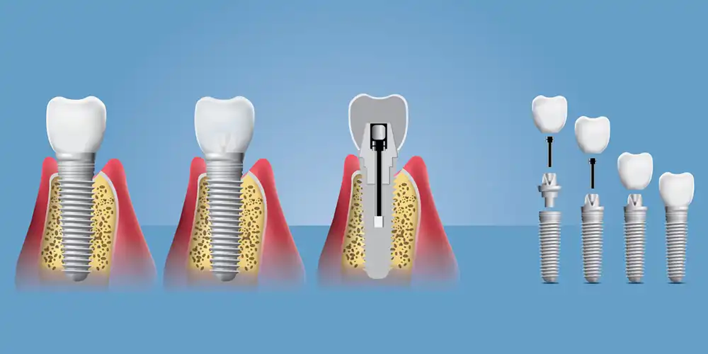 Dental Implants