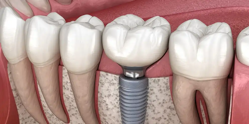 Dental Implants Reconstruction