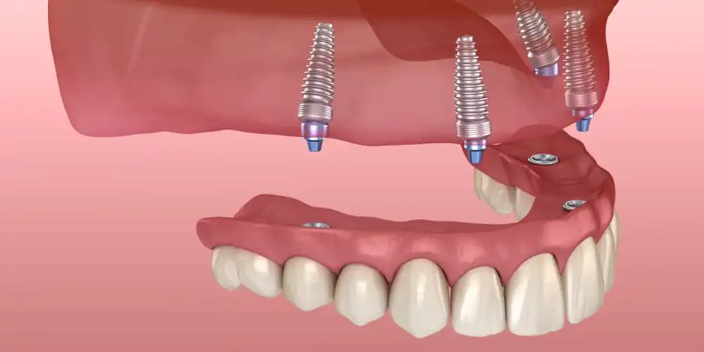 Implant-Supported Dentures