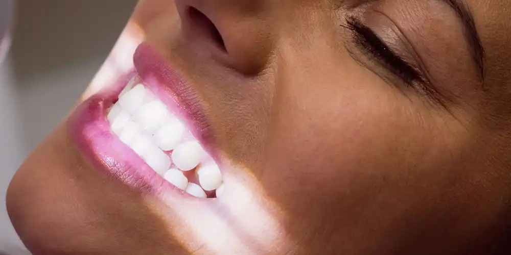 Full Mouth Reconstruction